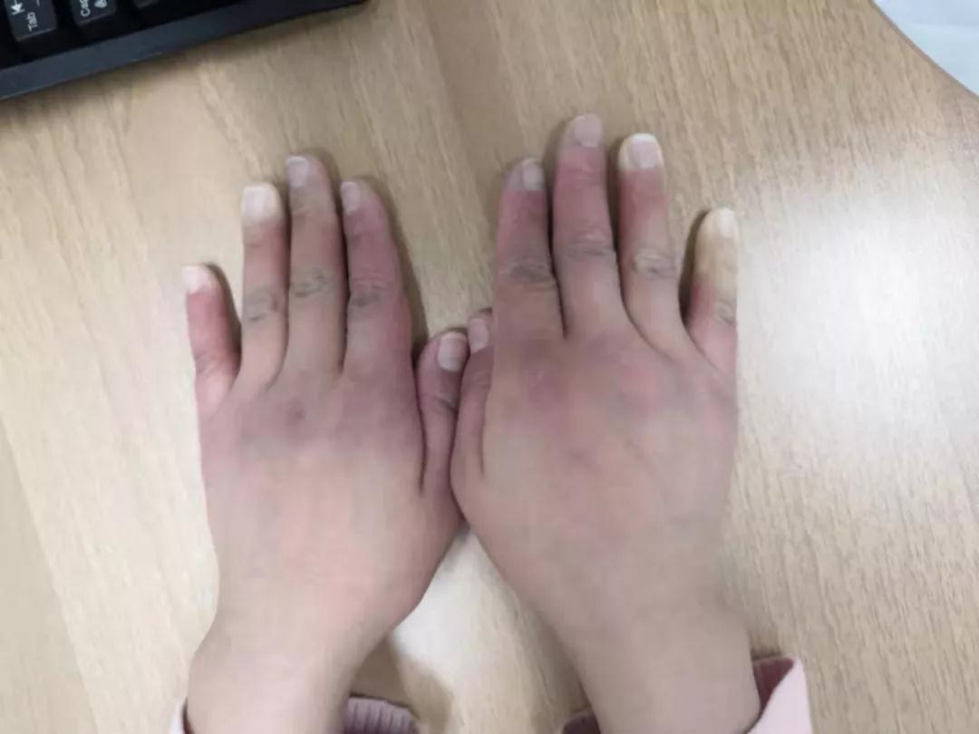 “手指、腳趾發(fā)白、發(fā)紫……”這些“小毛病”千萬別大意