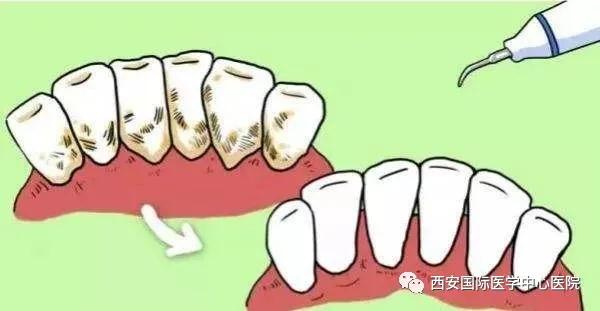 牙齒上的黃斑好難看，三招告訴你如何預(yù)防氟斑牙