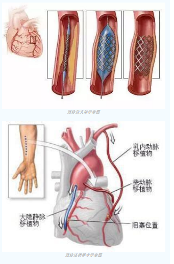 魚與熊掌不可兼得？冠脈雜交手術(shù)一站式解決問題