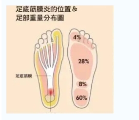 每年新生數(shù)百萬足底筋膜炎患者！國際醫(yī)學(xué)專家提醒：跑步要選擇合適的鞋